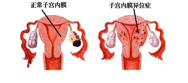 经历过的女性才能深切体会到,内异症这个在中青年女性中较高发的疾病